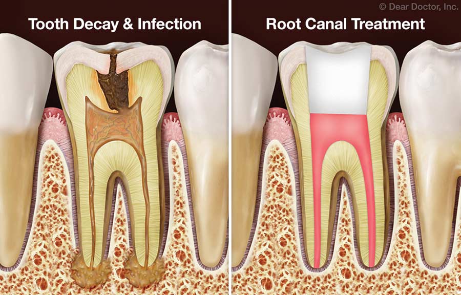Finding the right dentist for your root canal treatment